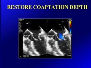 Mitral valve current challenges