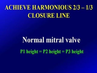 Mitral valve current challenges