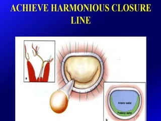 Mitral valve current challenges