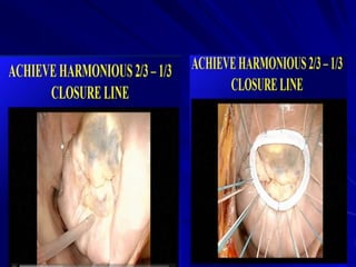 Mitral valve current challenges
