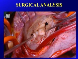 Mitral valve current challenges