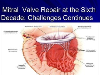 Mitral Valve Repair at the Sixth
Decade: Challenges Continues
 