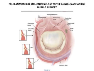 FOUR ANATOMICAL STRUCTURES CLOSE TO THE ANNULUS ARE AT RISK
DURING SURGERY
 