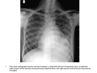 • The chest radiograph may be normal; however, a large left atrium is frequently seen. In patients
with severe mitral stenosis and pulmonary hypertension, the right atrium and ventricle may also be
enlarged.
 