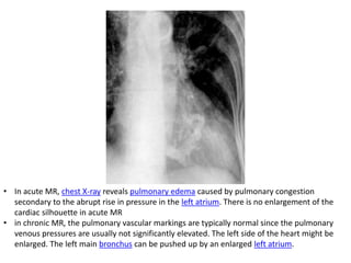 • In acute MR, chest X-ray reveals pulmonary edema caused by pulmonary congestion
secondary to the abrupt rise in pressure in the left atrium. There is no enlargement of the
cardiac silhouette in acute MR
• in chronic MR, the pulmonary vascular markings are typically normal since the pulmonary
venous pressures are usually not significantly elevated. The left side of the heart might be
enlarged. The left main bronchus can be pushed up by an enlarged left atrium.
 