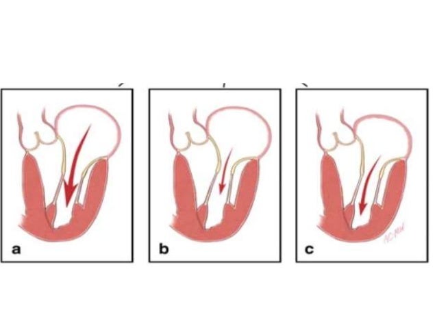 Mitral valve disease