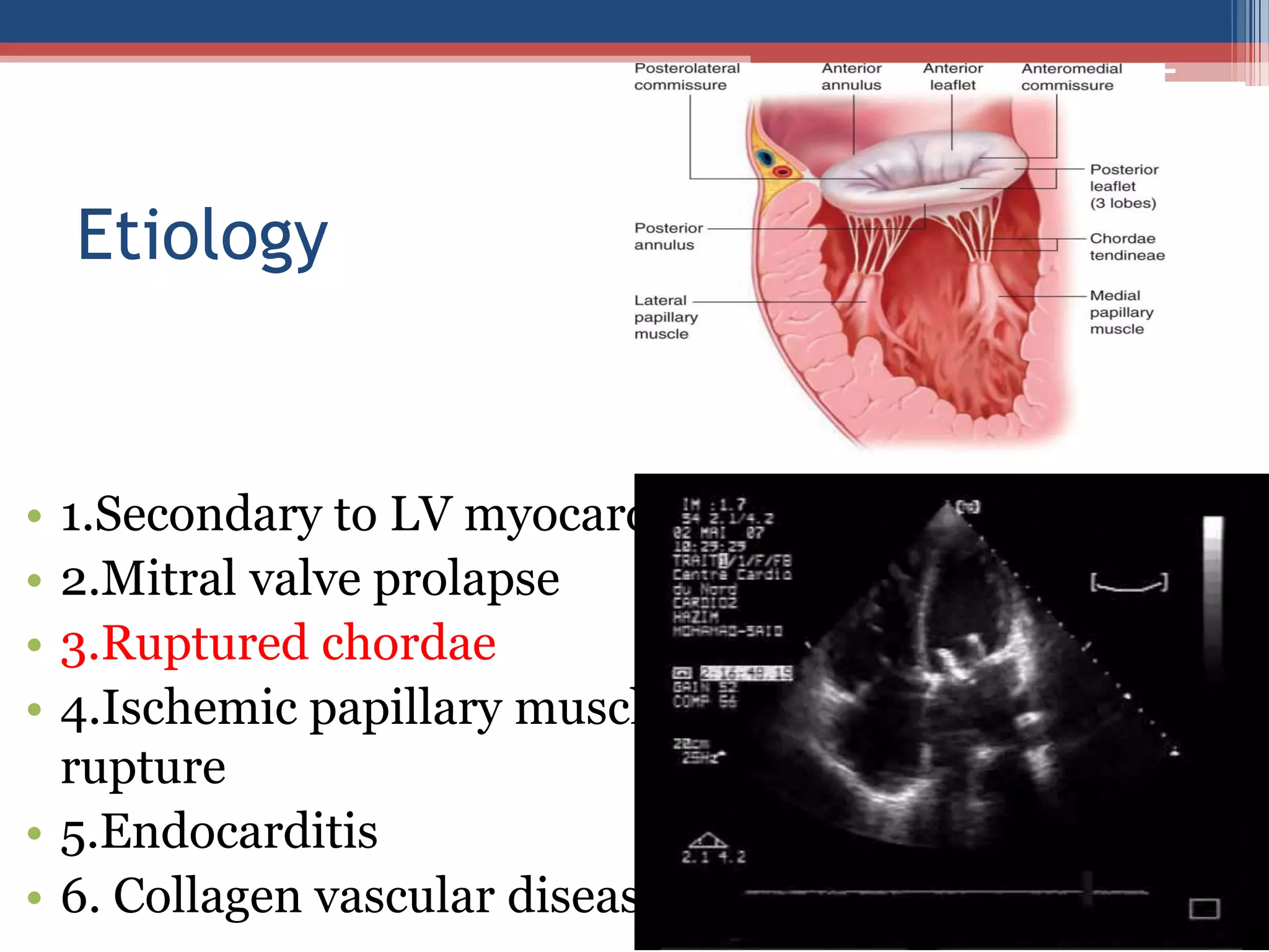 Mitral valve disease 2020 | PPT