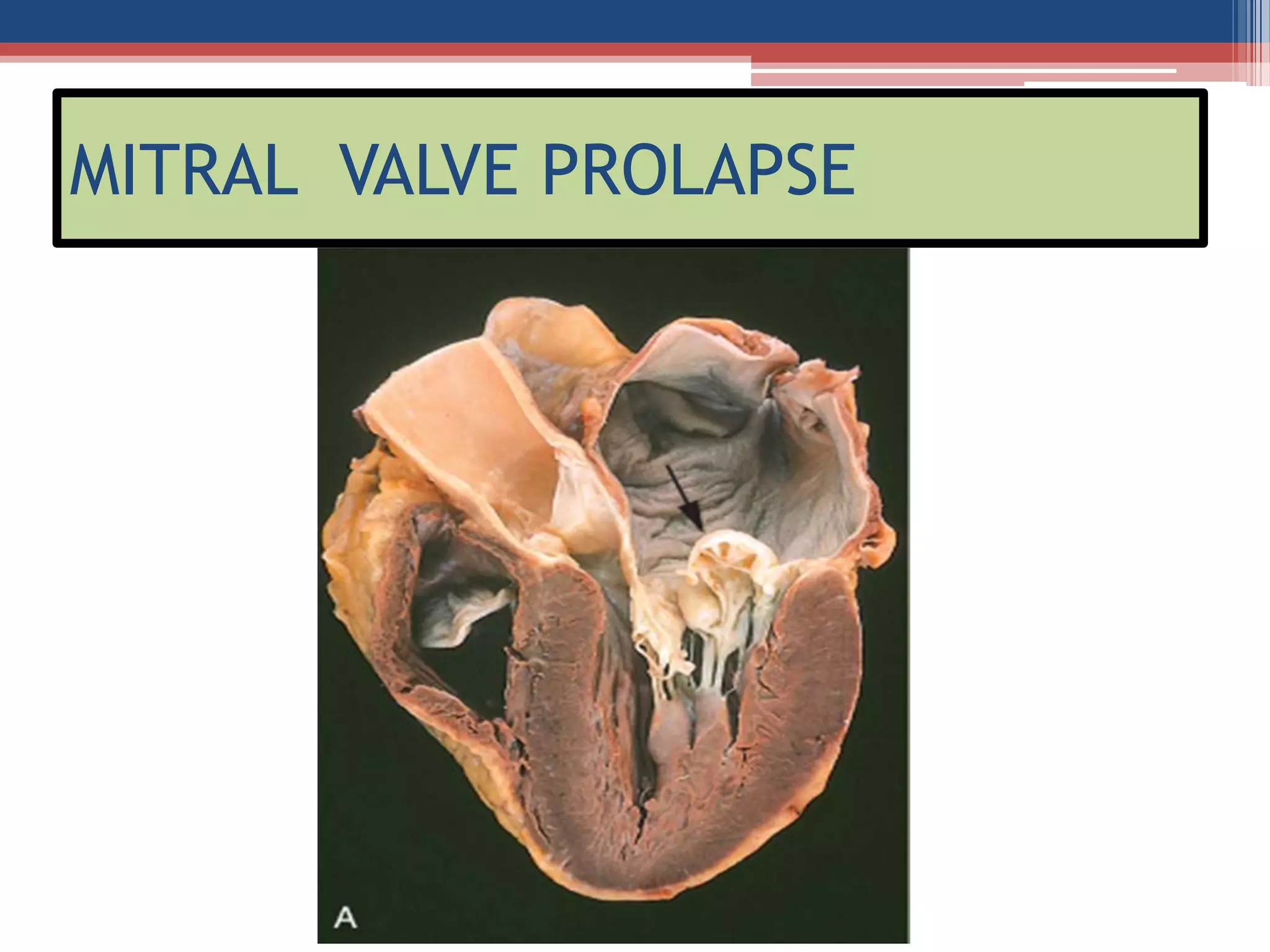 Mitral valve disease 2020 | PPT