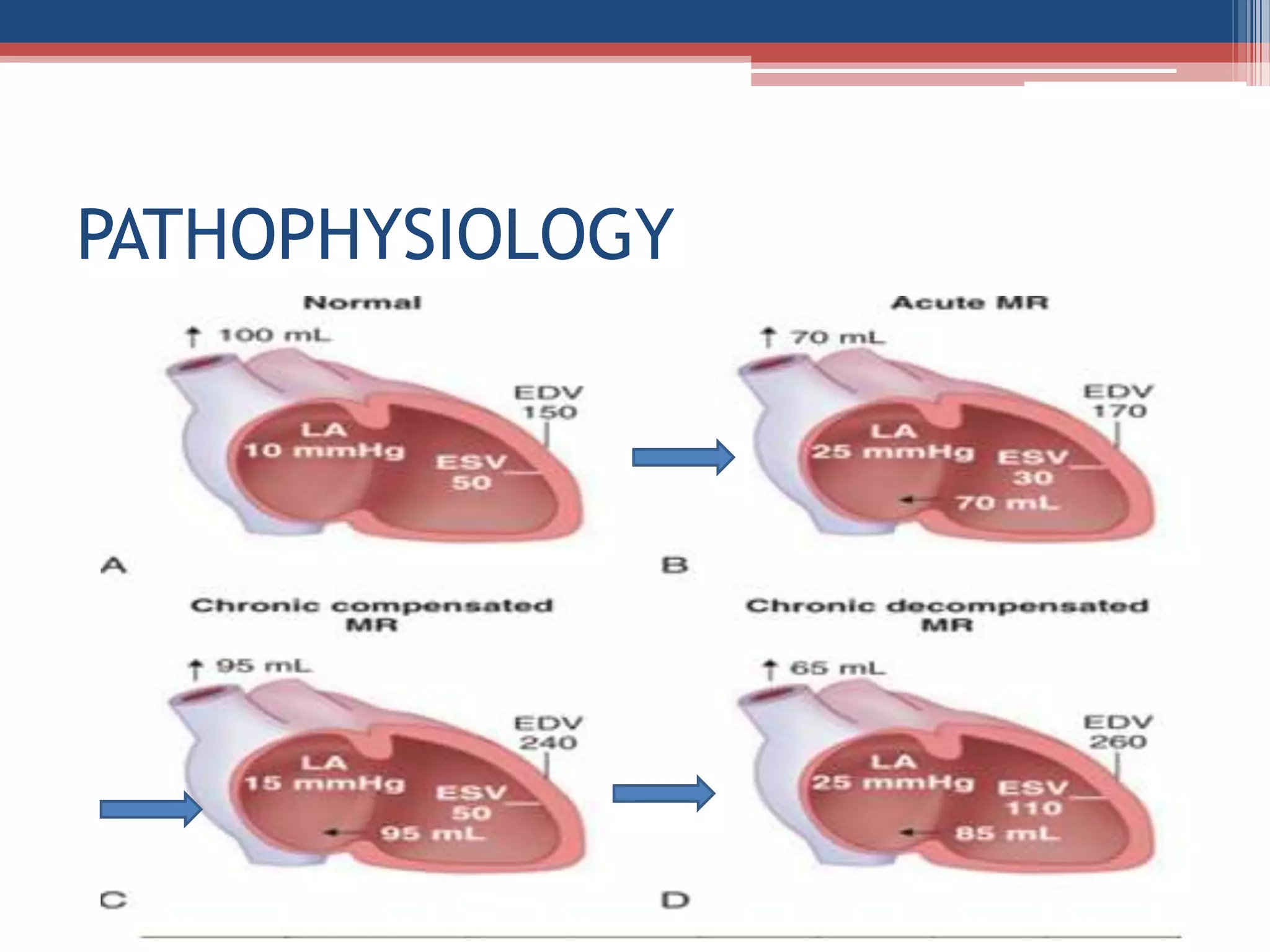 Mitral valve disease 2020 | PPT