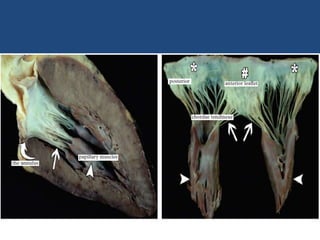 Mitral valve disease 2020 | PPT