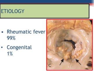 Mitral valve disease 2020 | PPT