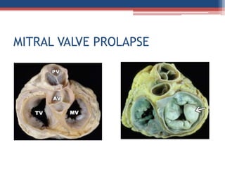 Mitral valve disease 2020 | PPT