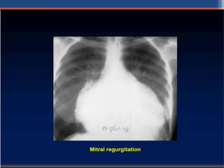Mitral valve disease 2020 | PPT