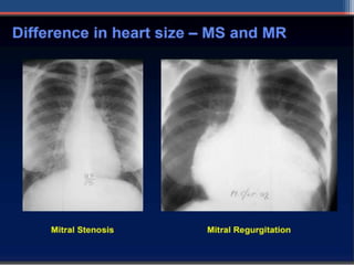 Mitral valve disease 2020 | PPT