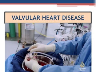 VALVULAR HEART DISEASE
 