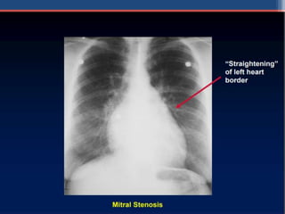Mitral valve disease 2020 | PPT