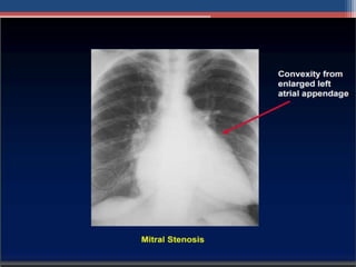 Mitral valve disease 2020 | PPT