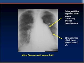 Mitral valve disease 2020 | PPT
