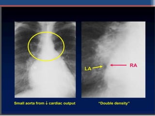 Mitral valve disease 2020 | PPT