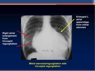 Mitral valve disease 2020 | PPT