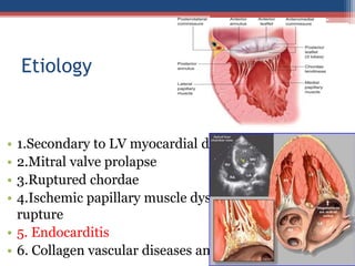 Papillary Dysfunction Mitral valve disease 2020 | PPT
