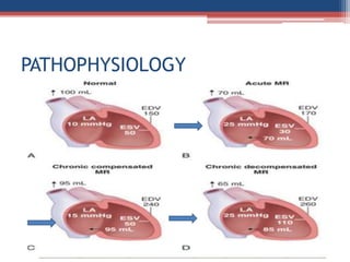 Mitral valve disease 2020 | PPT