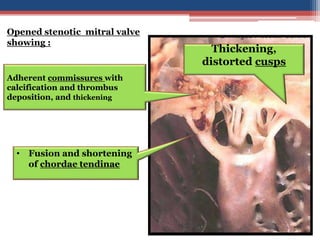 Commissore Drop Mitral valve disease 2020 | PPT