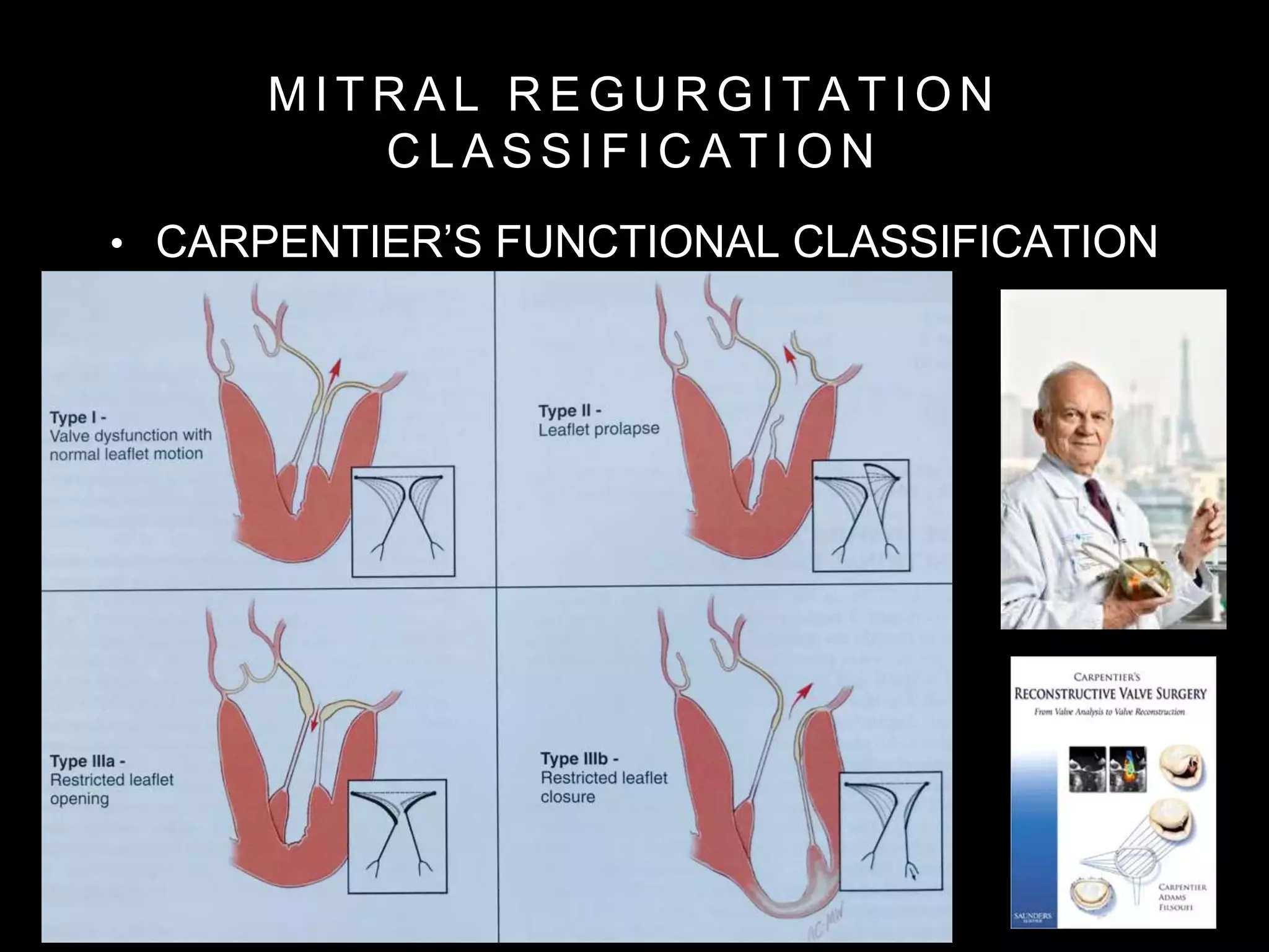 Mitral valve disease | PPTX