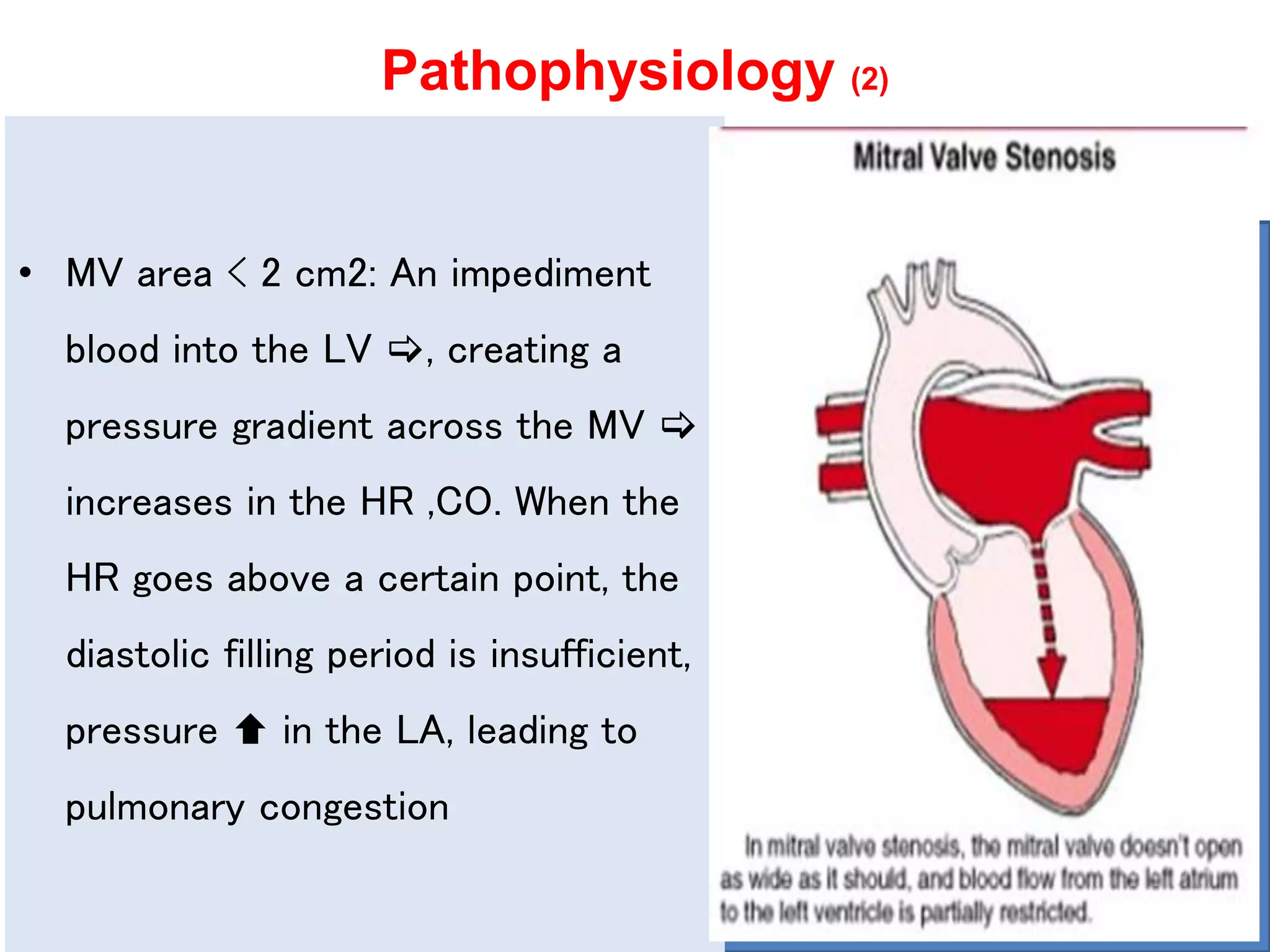 Mitral valve stenosis | PPTX