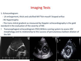 Imaging Tests
1. Echocardiogram:
- LA enlargement, thick and calcified MV"fish-mouth"shaped orifice
- RV Hypertrophic
- The trans-mitral gradient as measured by Doppler echocardiography is the gold
standard in the evaluation of the severity of MS
• Transesophageal echocardiogram (TEE):Wilkins scoring system to assess MV
morphology and its relationship to the success of percutaneous balloon dilation of
the MV
 