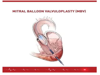 Mitral valve stenosis powerpoint | PPTX