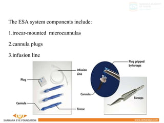 The ESA system components include:
1.trocar-mounted microcannulas
2.cannula plugs
3.infusion line
 