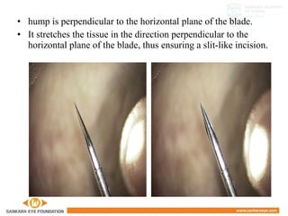 • hump is perpendicular to the horizontal plane of the blade.
• It stretches the tissue in the direction perpendicular to the
horizontal plane of the blade, thus ensuring a slit-like incision.
 