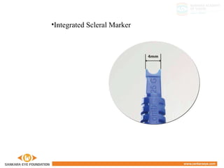 •Integrated Scleral Marker
 