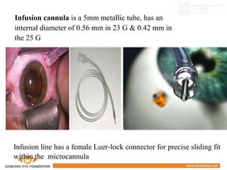 Infusion cannula is a 5mm metallic tube, has an
internal diameter of 0.56 mm in 23 G & 0.42 mm in
the 25 G
Infusion line has a female Luer-lock connector for precise sliding fit
within the microcannula
 