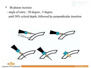• Bi-planar incision
- angle of entry : 30 degree , 5 degree
until 50% scleral depth, followed by perpendicular insertion
 