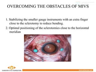OVERCOMING THE OBSTACLES OF MIVS
1. Stabilizing the smaller gauge instruments with an extra finger
close to the sclerotomy to reduce bending.
2. Optimal positioning of the sclerotomies close to the horizontal
meridian
 