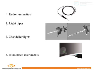 • Endoillumination
1. Light pipes
2. Chandelier lights
3. Illuminated instruments.
Two Categories of Fibres used
 