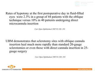 Rates of hypotony at the first postoperative day in fluid-filled
eyes were 2.3% in a group of 44 patients with the oblique
technique versus 10% in 40 patients undergoing direct
microcannula insertion
Curr Opin Ophthalmol 200718:188–193
UBM demonstrates that sclerotomy sites with oblique cannula
insertion heal much more rapidly than standard 20-gauge
sclerotomies or even those with direct cannula insertion in 25-
gauge surgery
Curr Opin Ophthalmol 200718:188–193
 