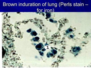 Brown induration ooff lluunngg ((PPeerrllss ssttaaiinn –– 
ffoorr iirroonn)) 
 