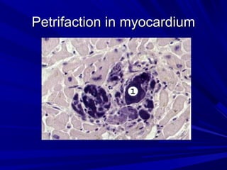 PPeettrriiffaaccttiioonn iinn mmyyooccaarrddiiuumm 
 