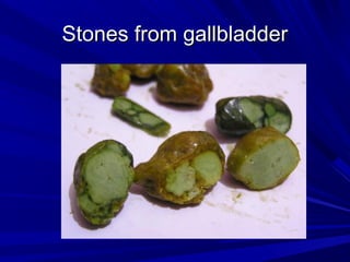 SSttoonneess ffrroomm ggaallllbbllaaddddeerr 
 