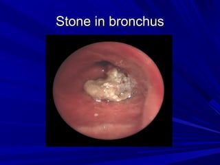 SSttoonnee iinn bbrroonncchhuuss 
 