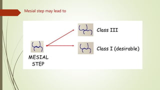 Mesial step may lead to
 
