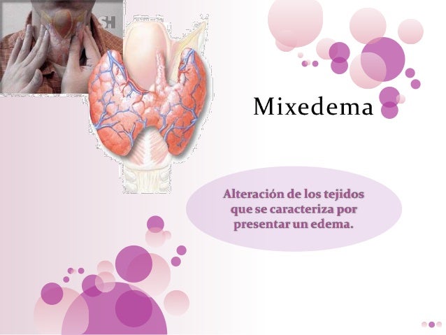 Mixedema