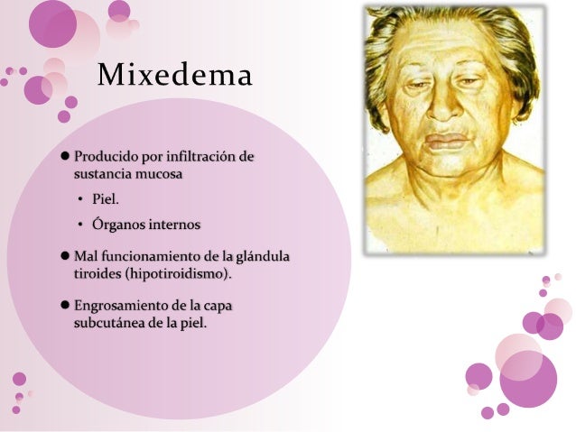Mixedema