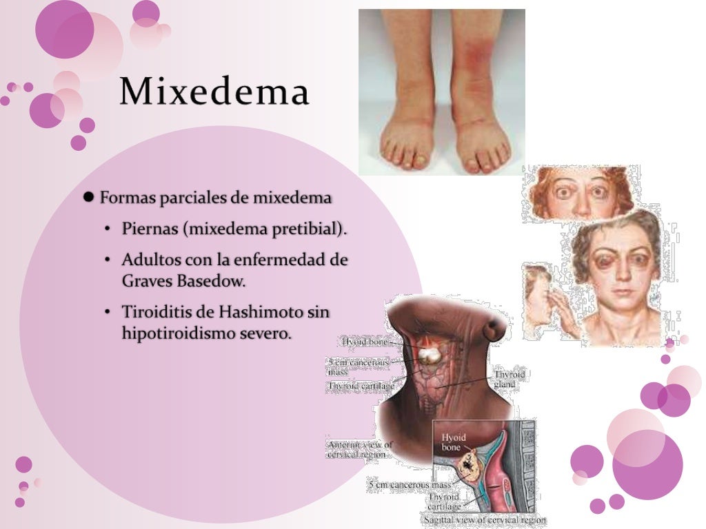 Mixedema