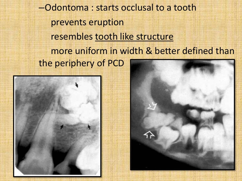 Mixed radiopaque & radiolucent lesions of jaw