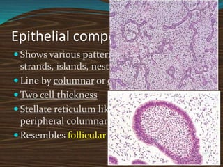 Epithelial component
 Shows various patterns like: rosettes,
strands, islands, nest, cords.
 Line by columnar or cuboidal cells
 Two cell thickness
 Stellate reticulum like cells surrounded by
peripheral columnar cells
 Resembles follicular stage of dental lamina
 
