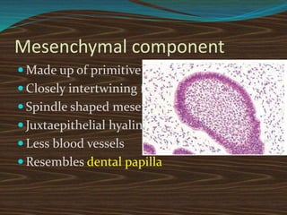Mesenchymal component
 Made up of primitive connective tissue
 Closely intertwining fibrils
 Spindle shaped mesenchymal cells
 Juxtaepithelial hyalinization
 Less blood vessels
 Resembles dental papilla
 